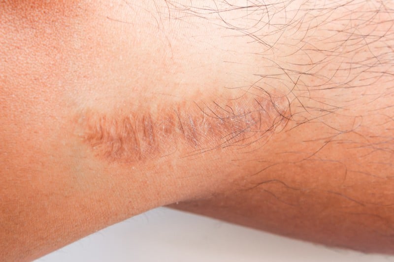 Have You Ever Wondered If Leg Lengthening Surgery Leave Scars?